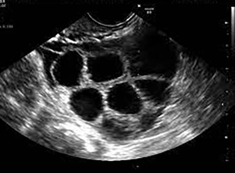 Follicles during IVF Monitoring Ultrasound